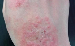 慢性湿疹偏方,缓解慢性湿疹不适