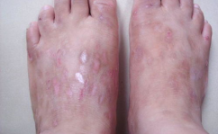 慢性湿疹偏方,缓解慢性湿疹不适